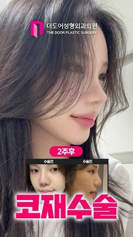 SHORTS 썸네일 — 2주후 / 수술전 수술전 코재수술
