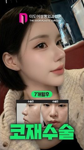 SHORTS 썸네일 — 7개월후 / 수술전 수술전 코재수술
