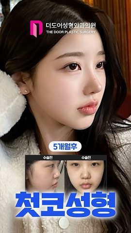 SHORTS 썸네일 — 5개월후 / 수술전 수술전 첫코성형