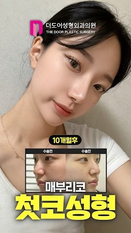 SHORTS 썸네일 — 10개월후 / 수술전 수술전 매부리코 첫코성형