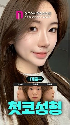 SHORTS 썸네일 — 11개월후 / 수술전 수술전 수술전 첫코성형