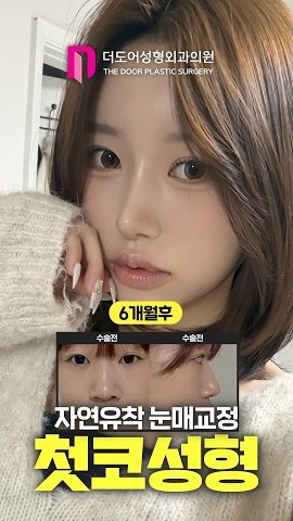 SHORTS 썸네일 — 6개월후 / 수술전 수술전 자연유착 눈매교정 첫코성형