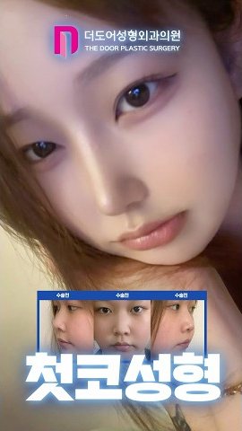 SHORTS 썸네일 — 수술전 수술전 수술전 첫코성형