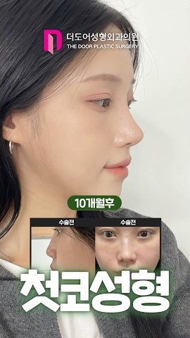 SHORTS 썸네일 — 10개월후 / 수술전 수술전 첫코성형