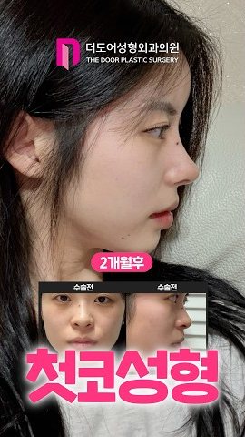 SHORTS 썸네일 — 2개월후 / 수술전 수술전 첫코성형