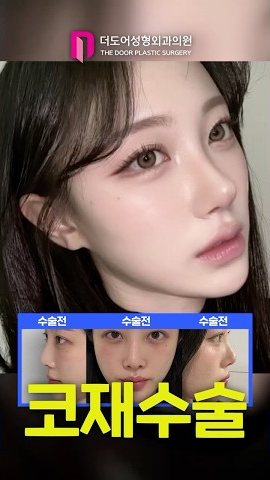 SHORTS 썸네일 — 수술전 수술전 수술전 코재수술