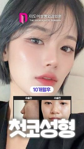 SHORTS 썸네일 — 10개월후 / 수술전 수술전 첫코성형