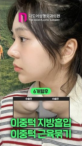 SHORTS 썸네일 — 6개월후 / 수술전 수술전 이중턱 지방흡입 이중턱 근육묶기