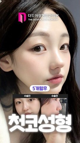 SHORTS 썸네일 — 5개월후 / 수술전 수술전 첫코성형