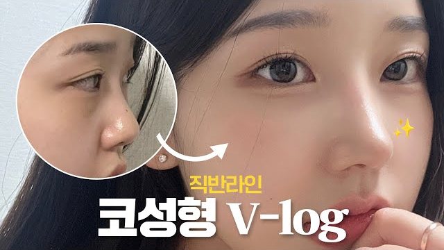 V LOG 썸네일 — 직반라인 코성형 V-log