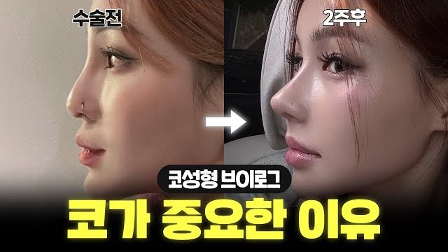 V LOG 썸네일 — 수술전 / 2주후 코성형 브이로그 코가 중요한 이유