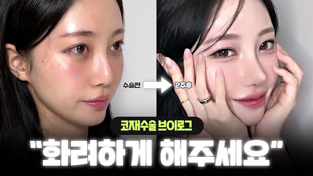 V LOG 썸네일 — 수술전 → 2주후 코재수술 브이로그 “화려하게 해주세요”