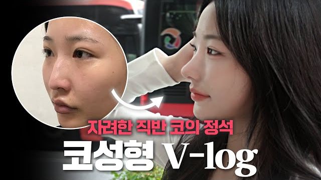 V LOG 썸네일 — 자려한 직반 코의 정석 코성형 V-log