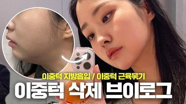 V LOG 썸네일 — 이중턱 지방흡입 / 이중턱 근육묶기 이중턱 삭제 브이로그