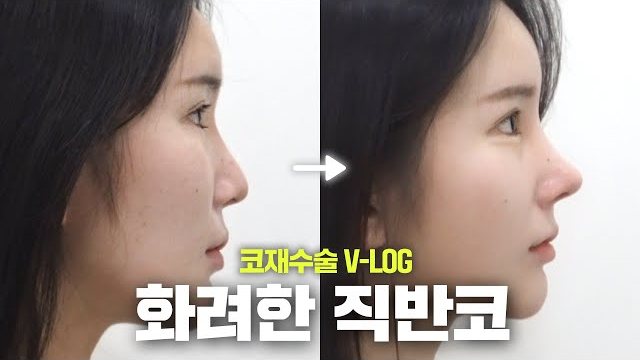 V LOG 썸네일 — 코재수술 V-LOG 화려한 직반코