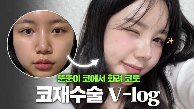 V LOG 썸네일 — 뚠뚠이 코에서 화려 코로 코재수술 V-log