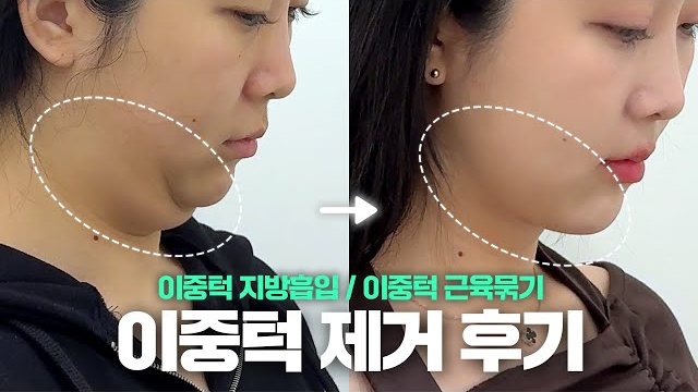 V LOG 썸네일 — 이중턱 지방흡입 / 이중턱 근육묶기 이중턱 제거 후기