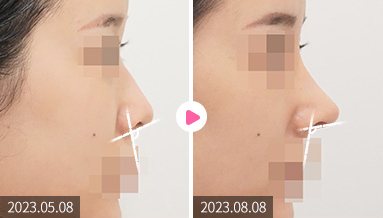 비순각 각도 조절 전후 옆모습 비교(2023.05.08 → 2023.08.08, 각도 표시선)