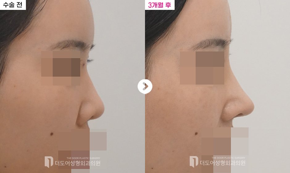 코 재수술 전후 — 측면(수술 전 / 3개월 후, 눈·입 모자이크)