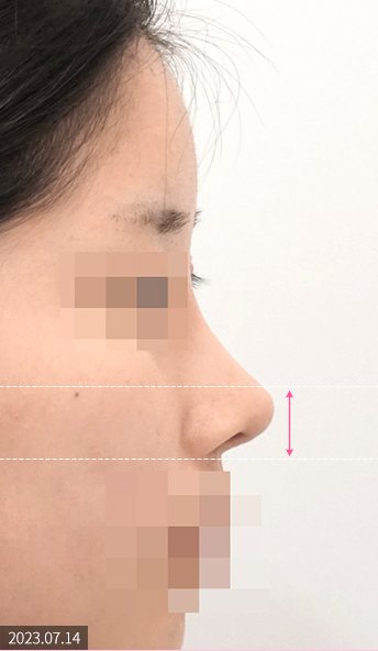 같은 환자 1개월 경과 옆모습(2023.07.14, 코끝 높이 표시선)