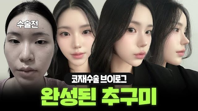 THEDOOR TV 썸네일 — 수술전 코재수술 브이로그 완성된 추구미