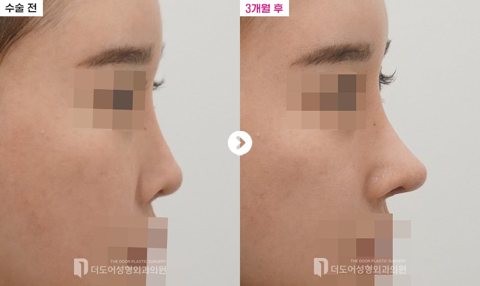 코 재수술 전후 — 측면(수술 전 / 3개월 후, 눈·입 모자이크)