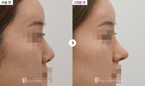 코 재수술 전후 — 측면(수술 전 / 3개월 후, 눈·입 모자이크)