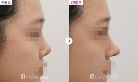 구축코 재수술 전후 — 측면(수술 전 / 3개월 후, 눈·입 모자이크)