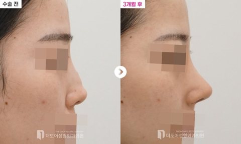 코 재수술 전후 — 측면(수술 전 / 3개월 후, 눈·입 모자이크)