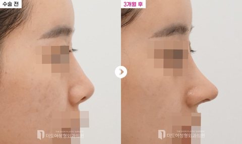 코 재수술 전후 — 측면(수술 전 / 3개월 후, 눈·입 모자이크)