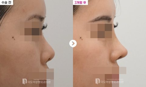 구축코 재수술 전후 — 측면(수술 전 / 3개월 후, 눈·입 모자이크)