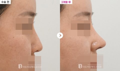 코 재수술 전후 — 측면(수술 전 / 3개월 후, 눈·입 모자이크)