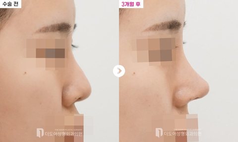 코 재수술 전후 — 측면(수술 전 / 3개월 후, 눈·입 모자이크)