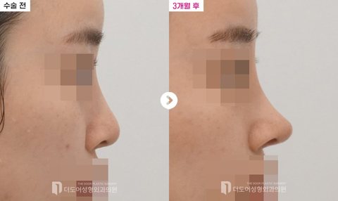 코 재수술 전후 — 측면(수술 전 / 3개월 후, 눈·입 모자이크)