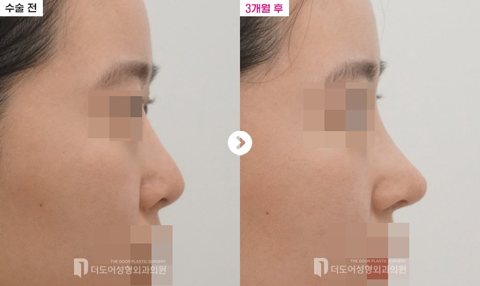 코 재수술 전후 — 측면(수술 전 / 3개월 후, 눈·입 모자이크)