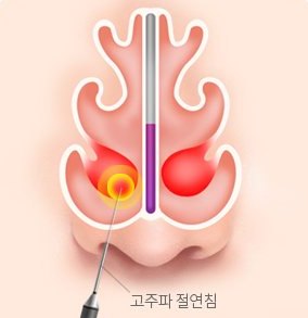 비염 코성형 설명 그림 — 코 속 단면 그림 — 고주파 절연침으로 비갑개를 치료하는 모습