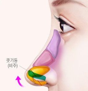 긴코·화살코 성형 설명 그림 — 옆모습 코 그림 — 콧기둥(비주)을 들어 올리는 화살표