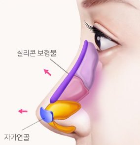 낮은코 성형 설명 그림 — 옆모습 코 그림 — 콧대 실리콘 보형물·코끝 자가연골