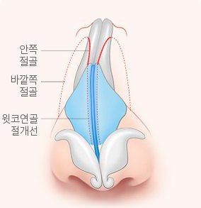 휜코 성형 설명 그림 — 정면 코뼈 그림 — 안쪽·바깥쪽 절골선과 윗코연골 절개선