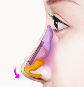 짧은코·들창코 성형 설명 그림 — 옆모습 코 그림 — 코끝을 아래로 늘이는 화살표