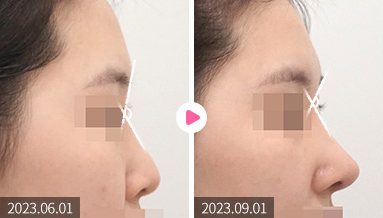 이마와 콧대 각도 조절 전후 옆모습 비교(2023.06.01 → 2023.09.01, 각도 표시선)