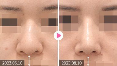 비주 길이 컨트롤 전후 정면 코 비교(2023.05.10 → 2023.08.10, 길이 화살표)