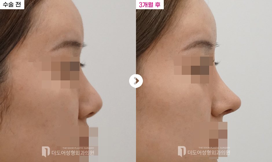 코 재수술 전후 — 전후사진