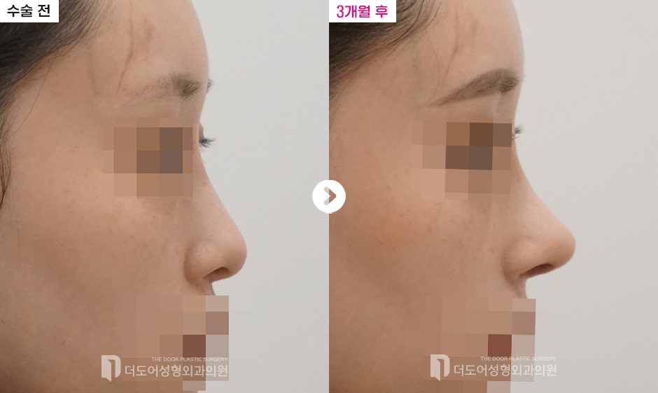 코 재수술 전후 — 전후사진