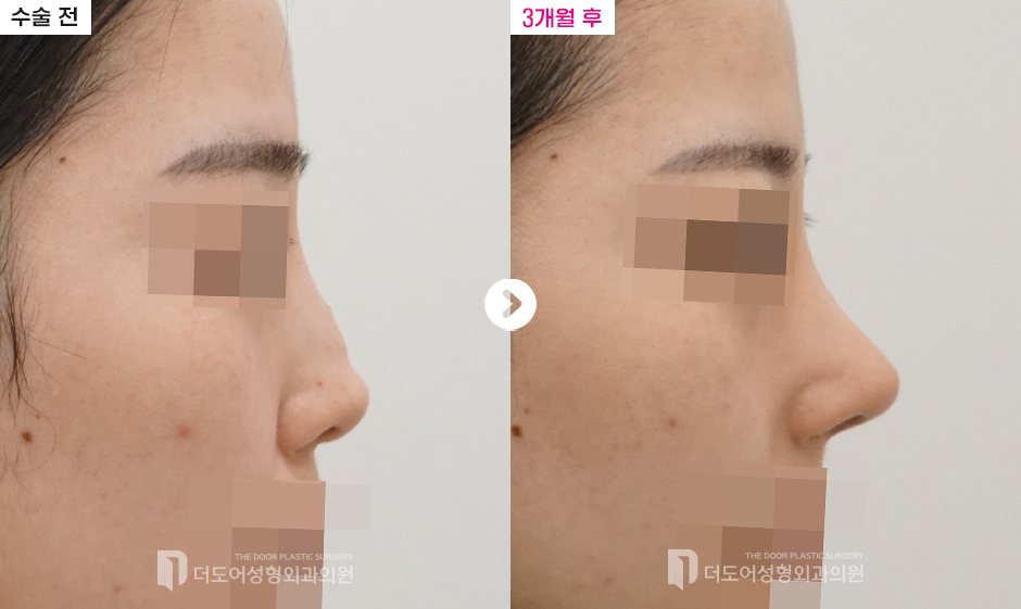 코 재수술 전후 — 전후사진