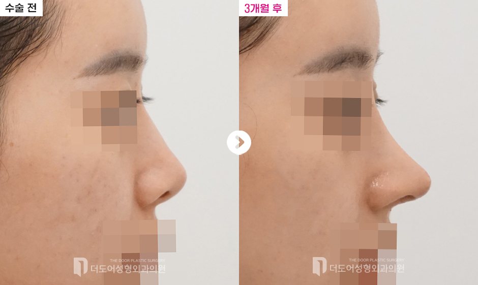 코 재수술 전후 — 전후사진