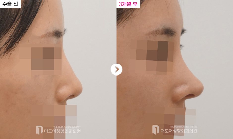 코 재수술 전후 — 전후사진