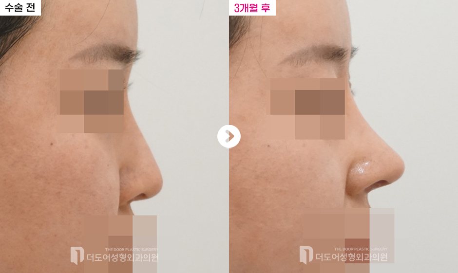 코 재수술 전후 — 전후사진