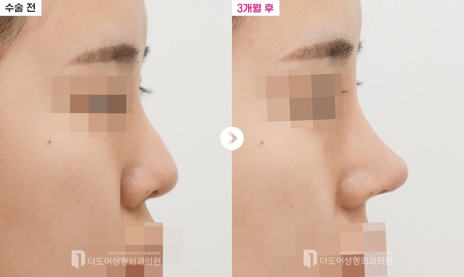 코 재수술 전후 — 전후사진