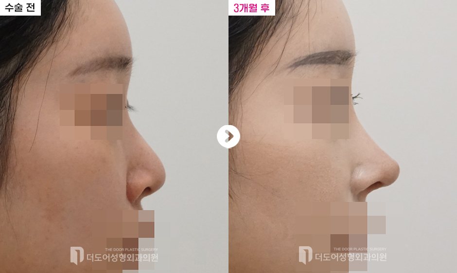 코 재수술 전후 — 전후사진